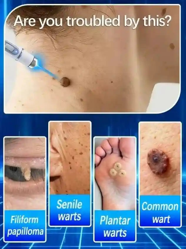 Home skin tag and wart removal device using blue light therapy to remove common, plantar, and senile warts safely.