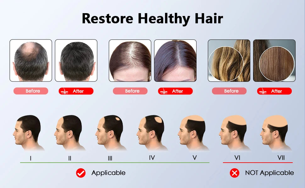 Before and after results of red light therapy hair growth cap showing efficacy for hair loss patterns and density.