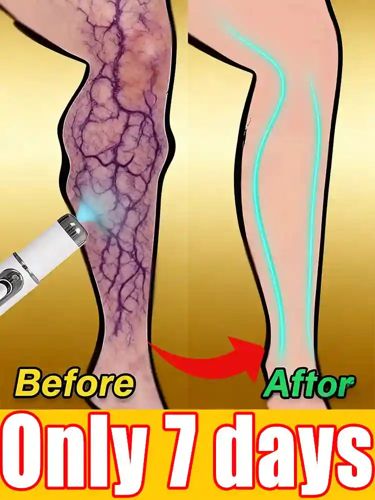 Varicose Vein Massage Roller Tool for Targeted Muscle Relief - Tidesmit Massage Roller Tidesmit