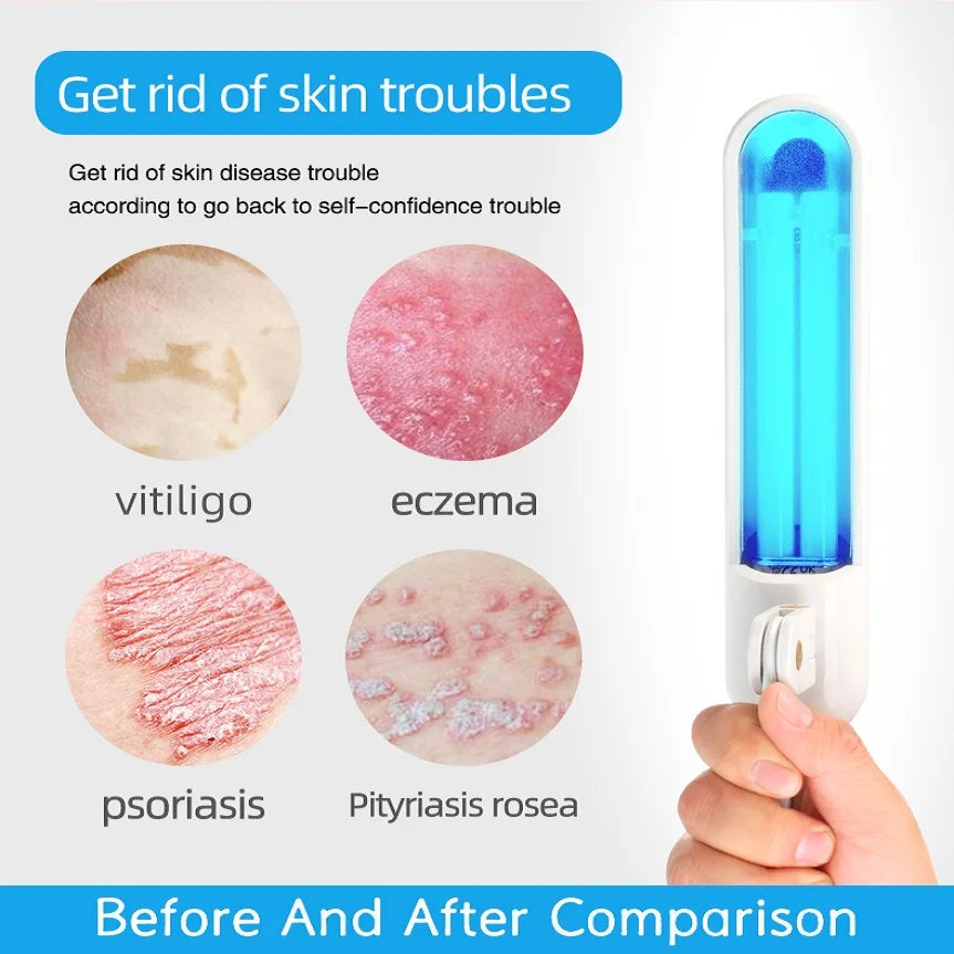 Portable 311nm handheld UVB light therapy lamp for treating vitiligo, psoriasis, and eczema at home.