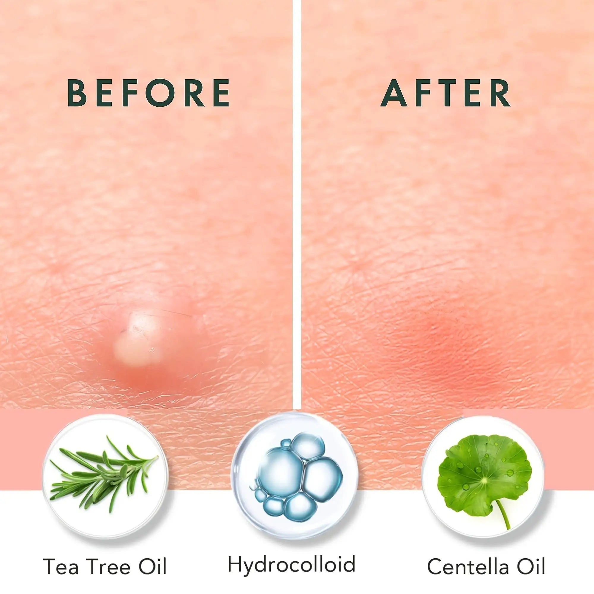 360/720 pieces/box of acne patches - non-alcoholic, used to absorb acne secretions, non irritating, essential for acne care