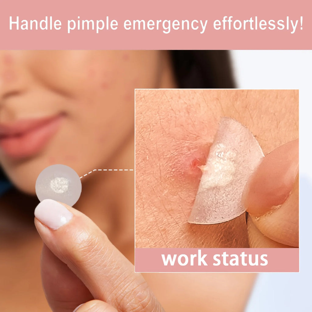 39Pcs Hydrocolloid Acne Patches, Professional Blemish Absorbing Pimple Stickers, Invisible Breathable Facial Skin Care Patch