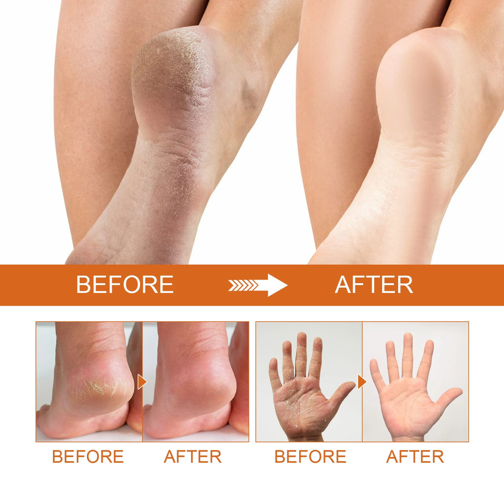 Exfoliating Foot Spray for Cracked Skin - Salon-Quality Repair Scrubs Treatments Tidesmit