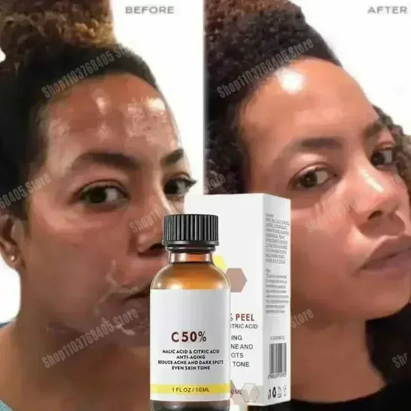 Salicylic Acid Face Peel - Professional Deep Exfoliation & Skin Refinement Scrubs Treatments Tidesmit