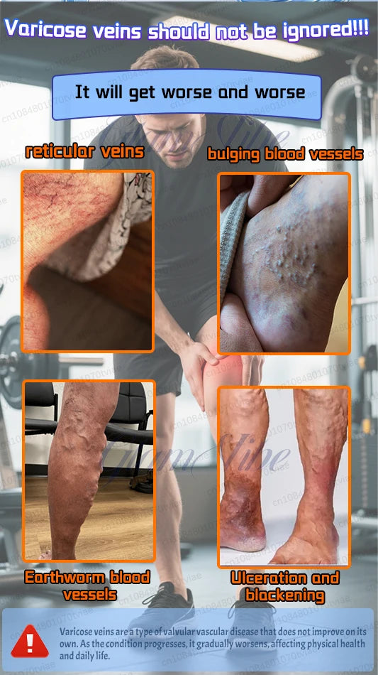 Collage showing various stages of varicose veins, including reticular, bulging, and ulcerated leg conditions.