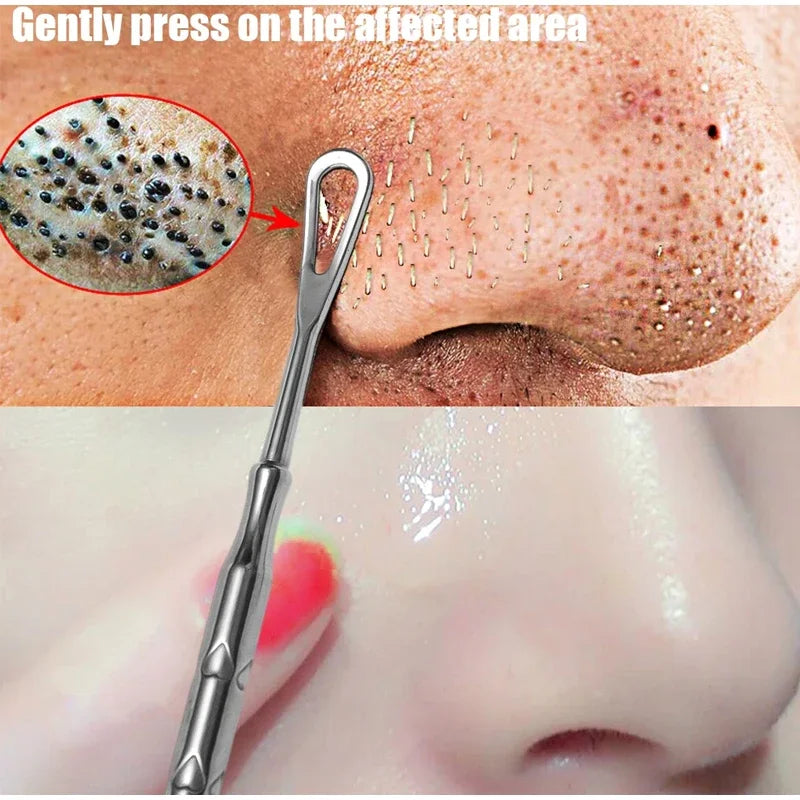Blackhead Remover Tool Kit 4pc - Professional Stainless Steel Acne Set Scrubs Treatments Tidesmit
