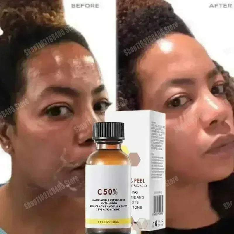 Salicylic Acid Peeling Lotion for Dark Skin | Professional Exfoliation Scrubs Treatments Tidesmit