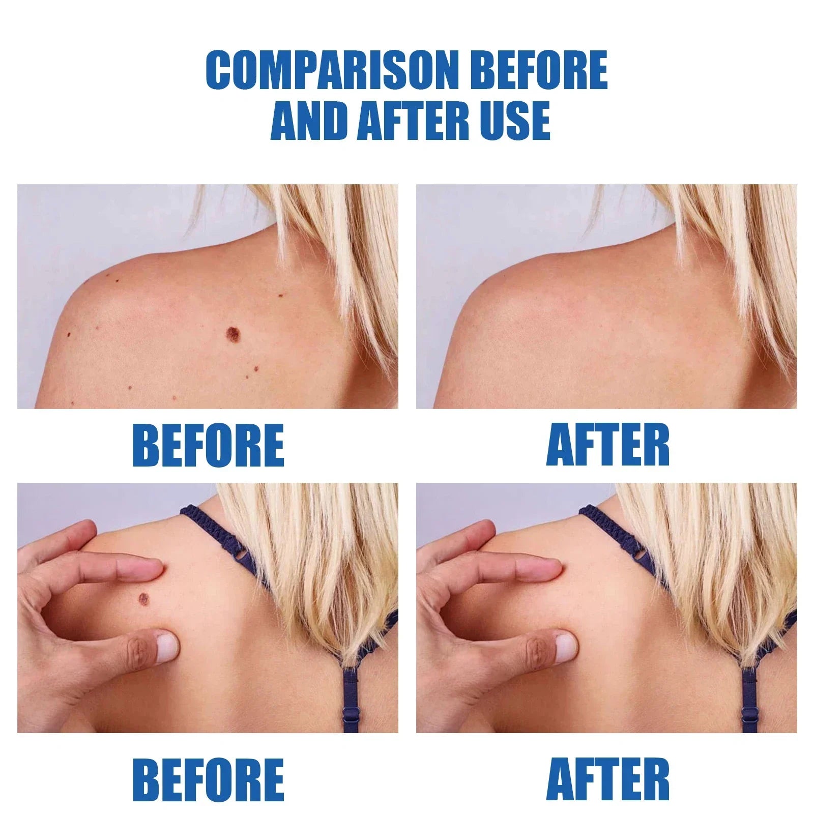 Wart Removal Laser Pen - Painless Home Skin Treatment Tool | Tidesmit Relaxation Treatment Tidesmit