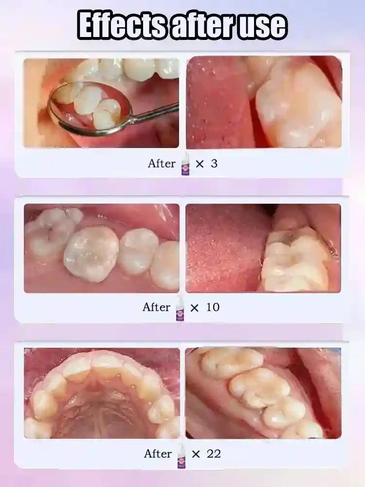 Tidesmit teeth whitening and cavity repair serum for deep enamel remineralization and tooth decay protection