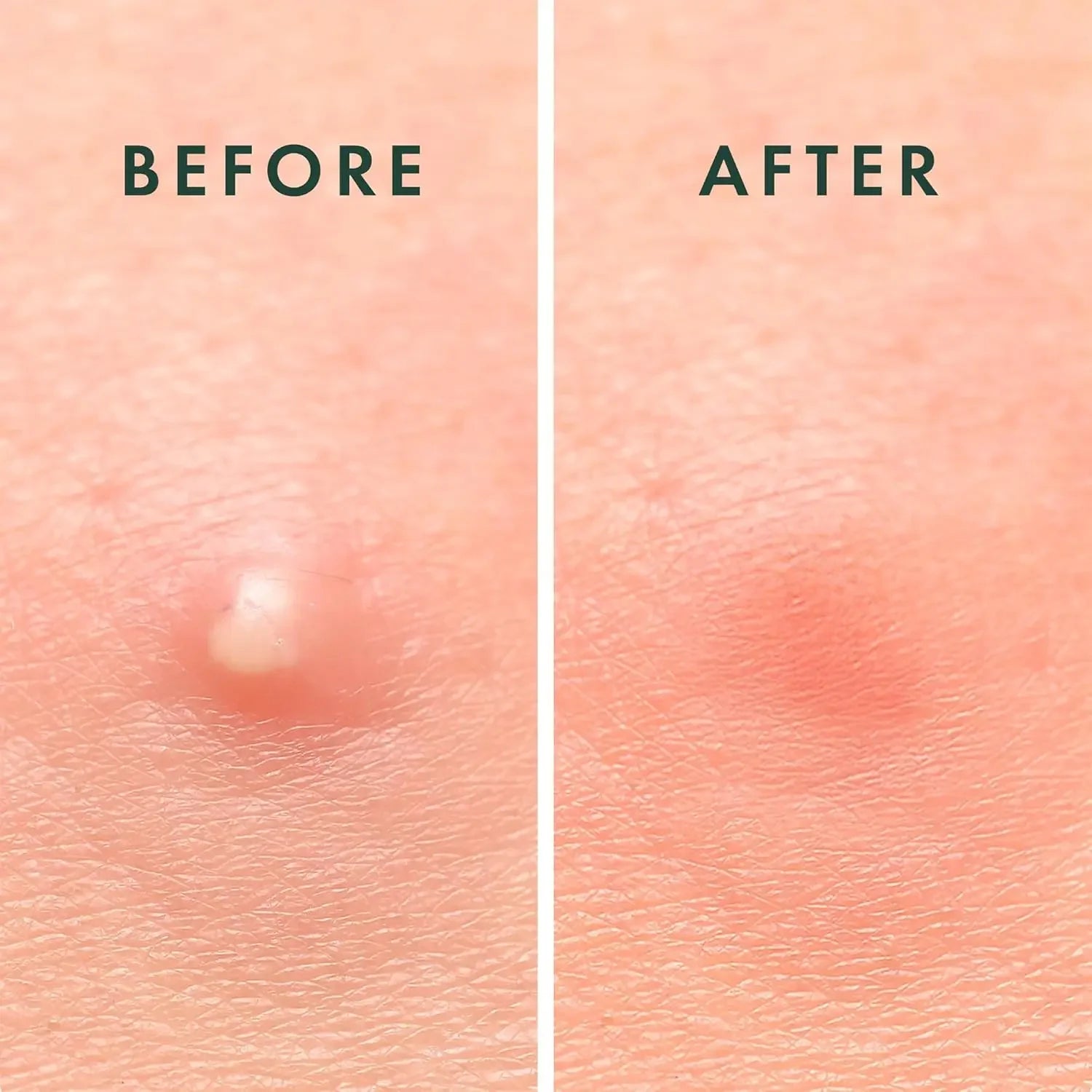 Hydrocolloid Acne Pimple Patches for Face Shrinking Zits Whiteheads Nighttime Spot Pimple Stickers for Face Skin Care Tools