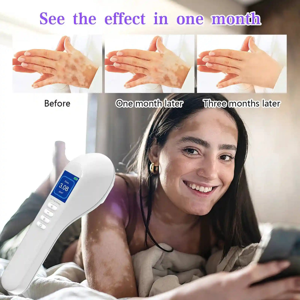 Handheld white UV phototherapy device for skin condition treatment with a digital display and control buttons.