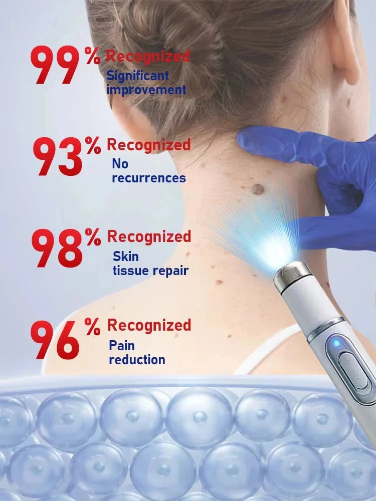 Wart Removal Blue Light Laser Pen - Portable Dermatological Skin Care Lip Care Tidesmit