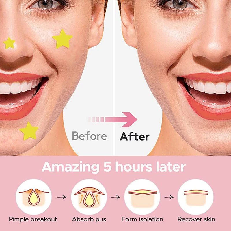 112 PCS/SET Star Pimple Patch Acne Colorful Invisible Acne Removal Skin Care Stickers Concealer Face Spot Beauty Skin Care Tools