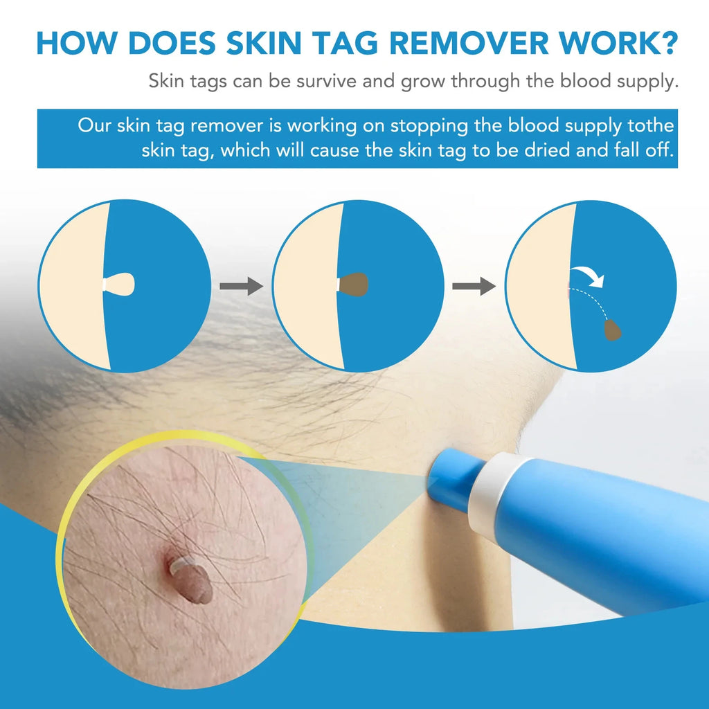 2-in-1 painless skin tag and mole removal kit in blue, showing process steps to dry and remove tags from face or body.
