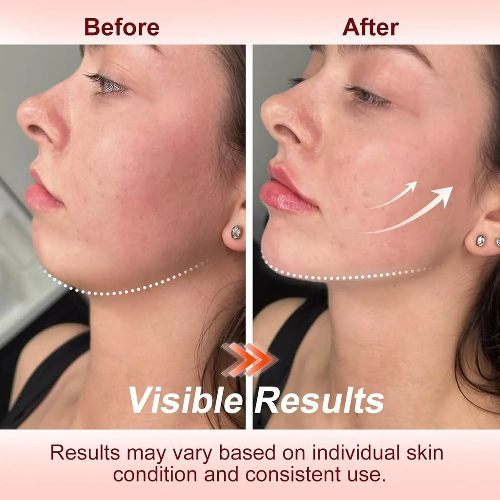 Before and after comparison of a woman’s jawline showing facial contouring results with upward lift indicators.
