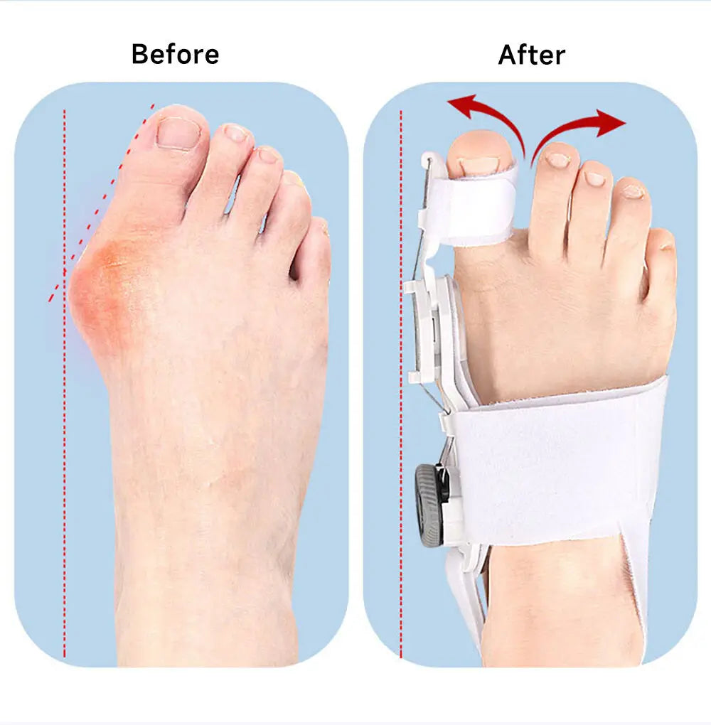 Bunion Corrector Adjustable Toe Straightener for Foot Pain Relief Relaxation Treatment Tidesmit