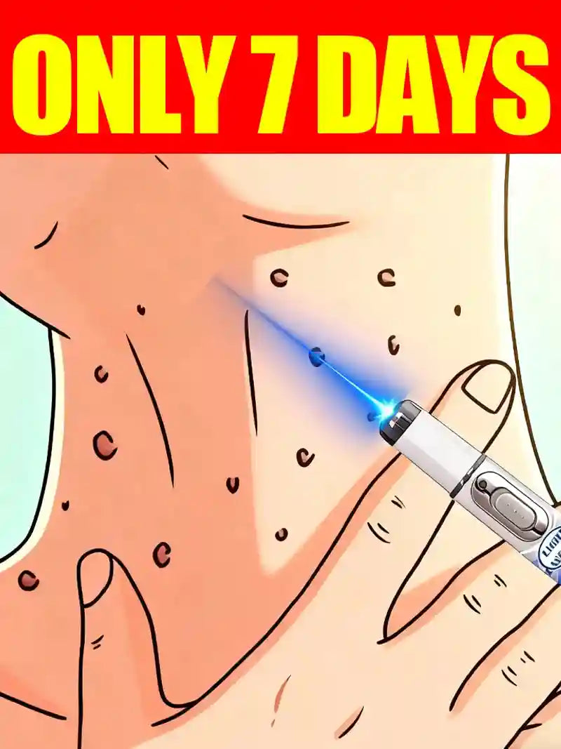 Blue Light Wart Removal Pen - Non-Invasive Skin Care Tool | Tidesmit Lip Care Tidesmit