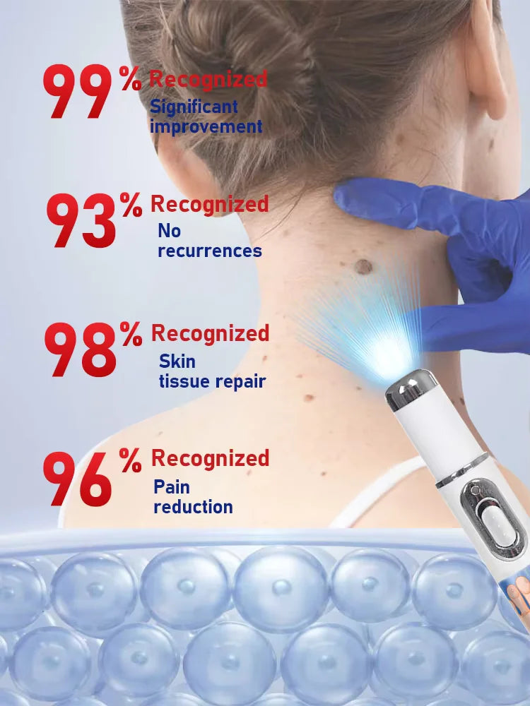 Wart Removal Pen | Painless Skin Tag Laser Device | Tidesmit (1pc/2pc) Relaxation Treatment Tidesmit