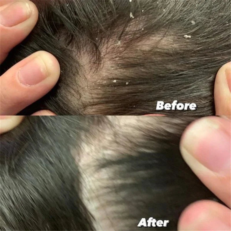 Anti Dandruff Scalp Scrub Treatment for Itch Relief - Tidesmit Scrubs Treatments Tidesmit