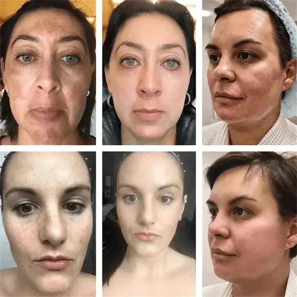 Before and after photos of women showing reduced facial hyperpigmentation and skin texture improvement after treatment.