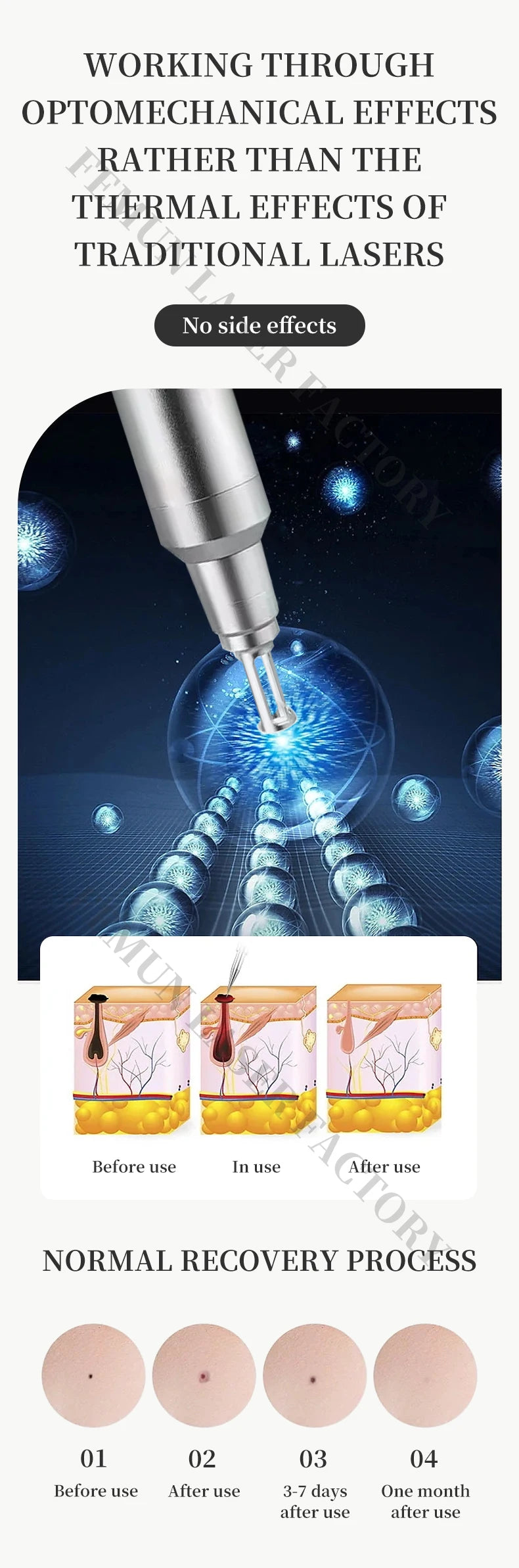Portable 4000W Nd:YAG picosecond laser machine for tattoo removal showing skin recovery process and laser head detail.