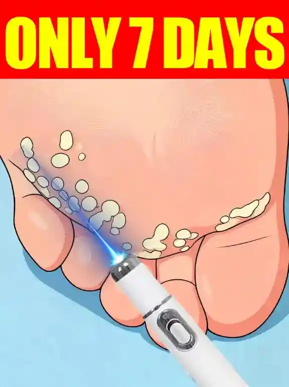 Wart Remover Laser Roller - 7-Day Precision Skin Treatment Tool Massage Roller Buy 10 Get 12 Free Tidesmit