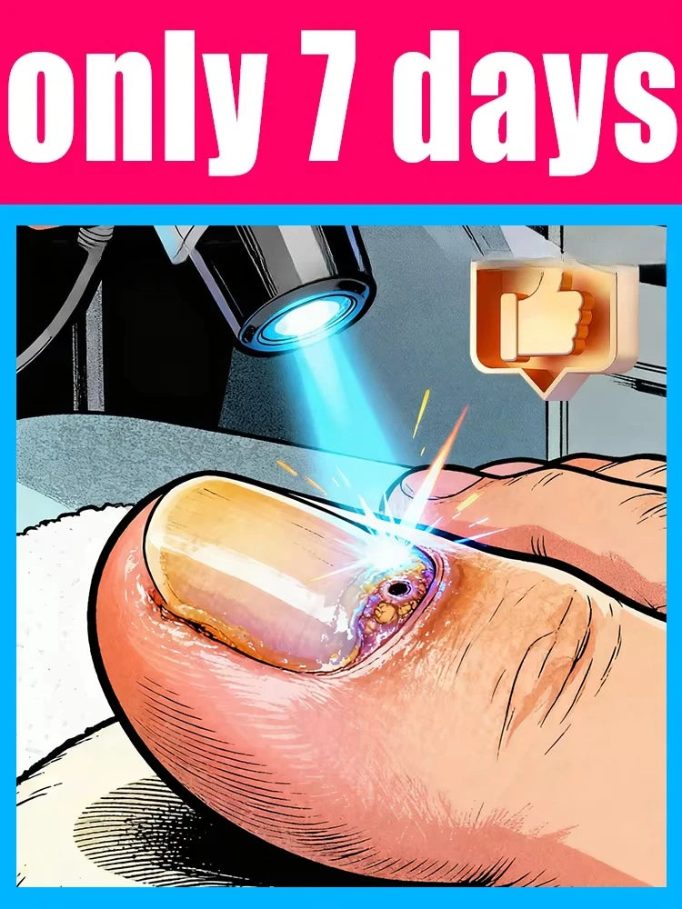 Laser Nail Fungus Treatment Pen - Portable Wellness Relief Device Relaxation Treatment Tidesmit