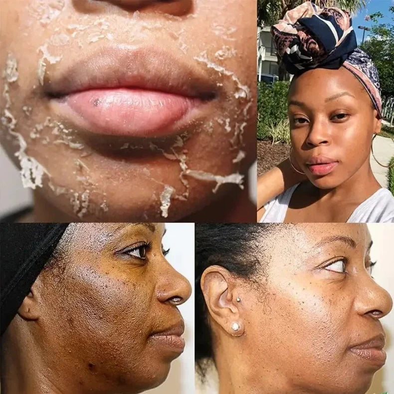 Yellow Peeling Oil for Dark Skin - Professional Exfoliating Treatment Scrubs Treatments Tidesmit