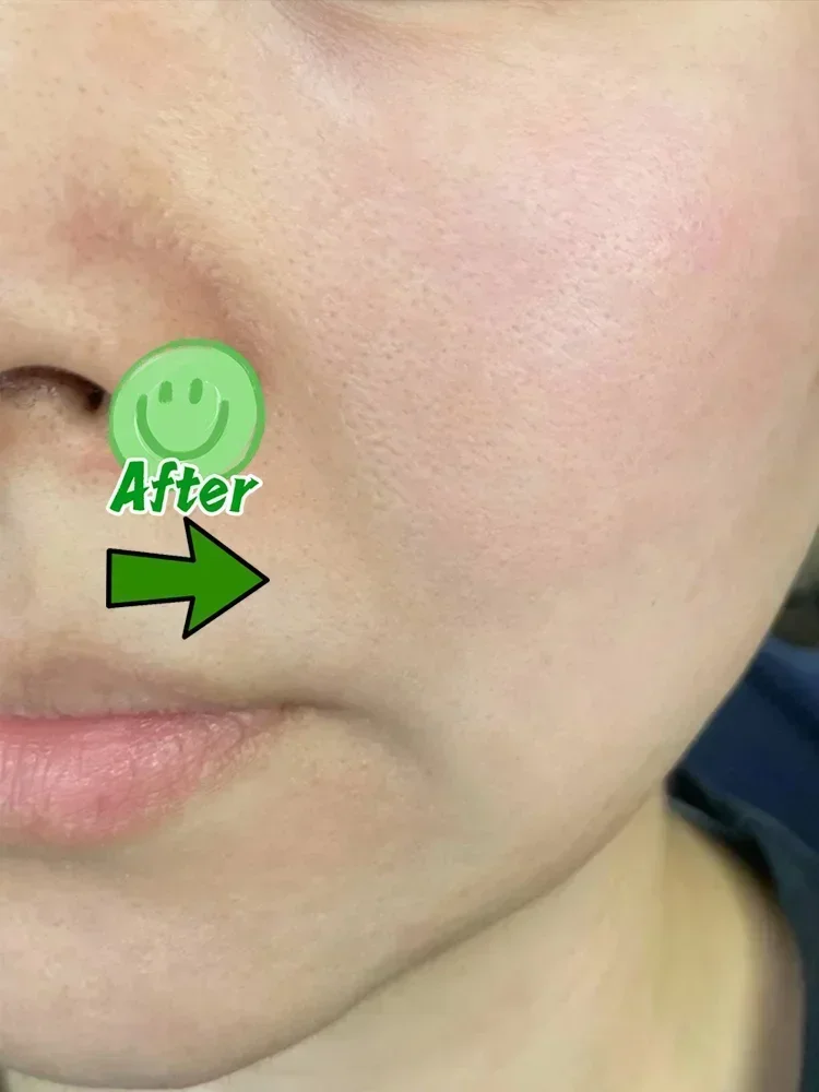 Acne Scar Cream for Face & Pore Fading Treatment | Tidesmit Scrubs Treatments Tidesmit