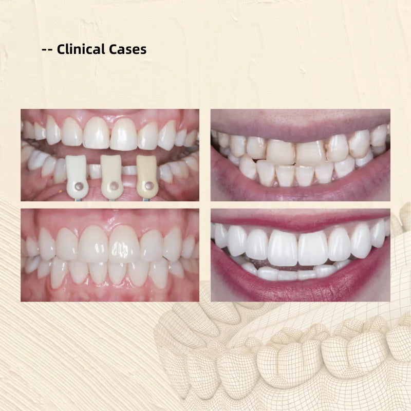 20pcs LODDEN Dental Lab Lithium Disilicate Without Sintering Glass Ceramic Blocks HT/LT CADCAM Sirona Veneer Materials Wholesale