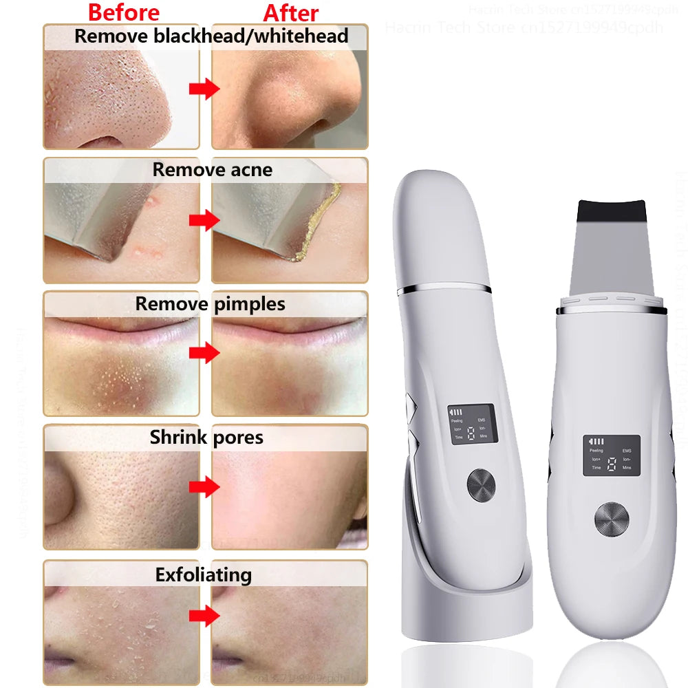 Ultrasonic Face Scrubber - Deep Pore Cleaning & Blackhead Removal Device Scrubs Treatments Tidesmit
