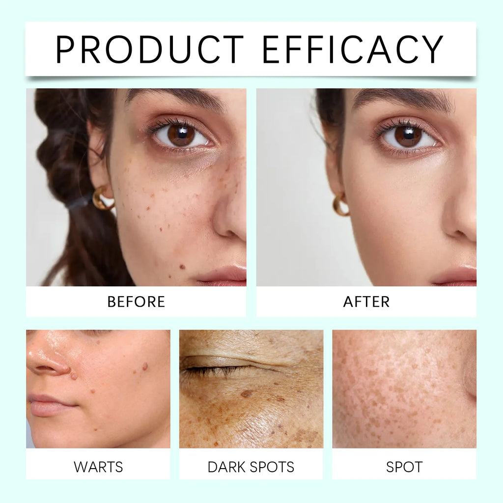 Before and after comparison of skin treatment for reducing facial warts, dark spots, and hyperpigmentation.