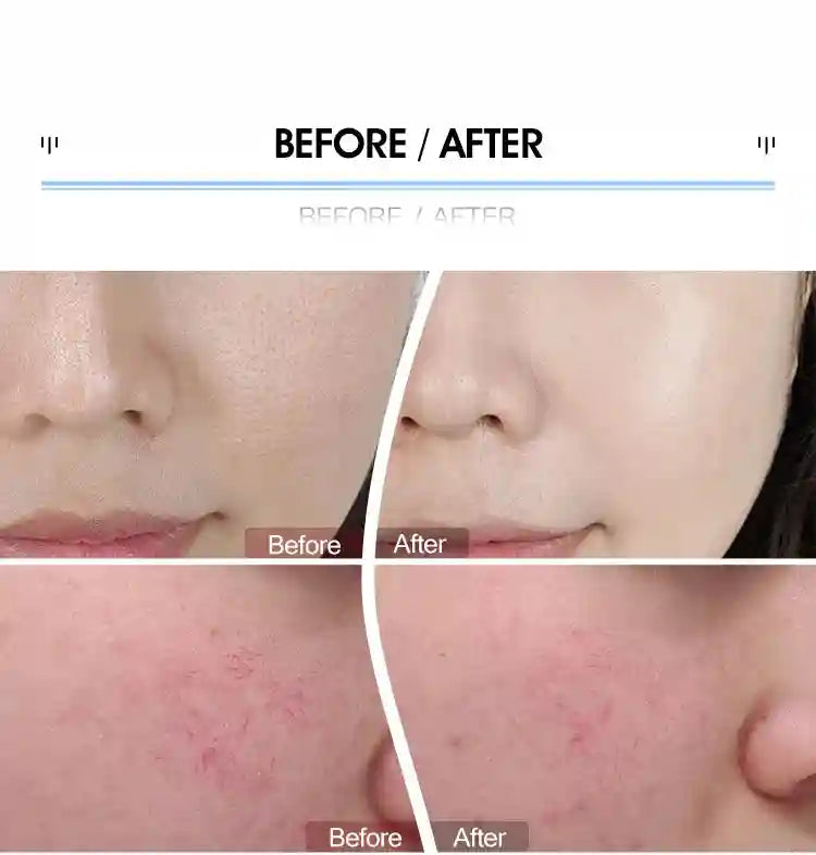 Before and after results showing improved skin texture and redness reduction using 7-color LED light therapy mask.