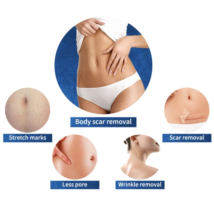 Portable fractional RF device for stretch mark, scar, and wrinkle removal on face and body skin tightening treatment.