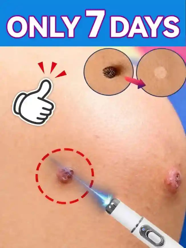 Wart Removal Blue Light Pen: Painless Skin Tag and Lip Care Solution Lip Care Pack of 1 Tidesmit