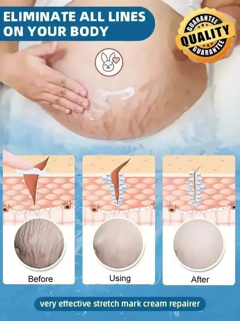 Stretch Mark Repair Cream for Pregnancy Postpartum Skin Recovery Relaxation Treatment Tidesmit