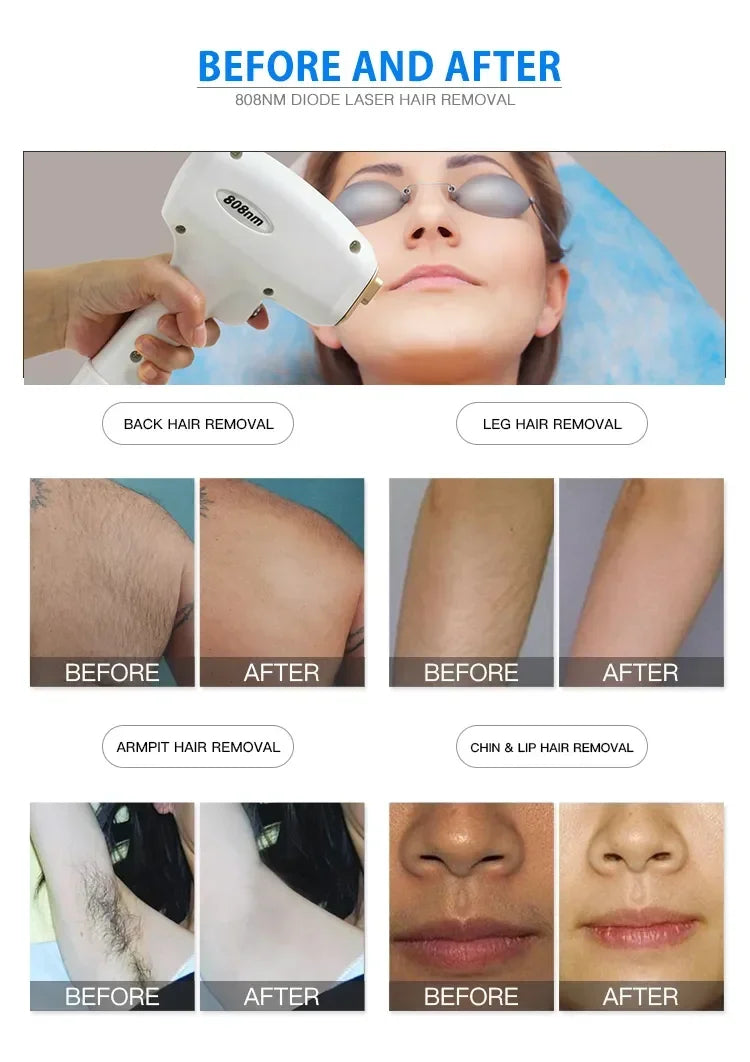808nm Diode Laser Hair Removal Machine – Professional Grade Device Permanent Makeup Machines Tidesmit