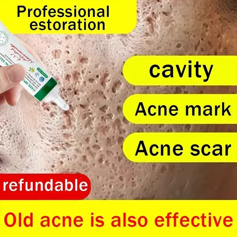 Acne Scar Removal Cream for Pore Repair & Skin Texture - Tidesmit Scrubs Treatments Tidesmit