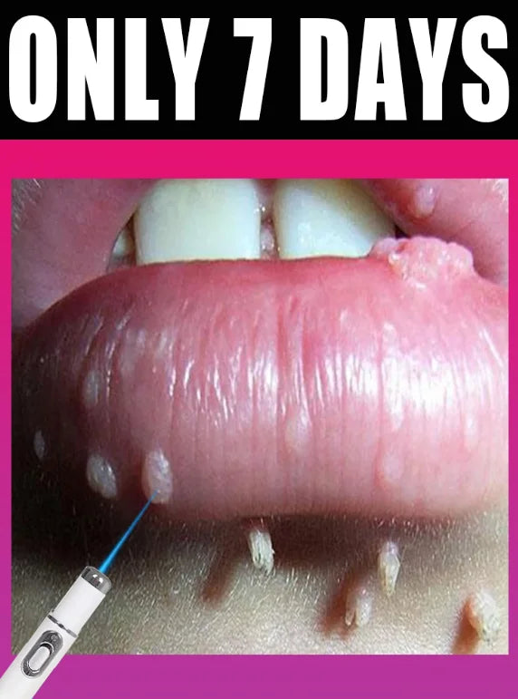 Blue Light Laser Pen for Skin Tag and Wart Removal - Tidesmit EU Relaxation Treatment Buy 3 Get 2 Free Tidesmit