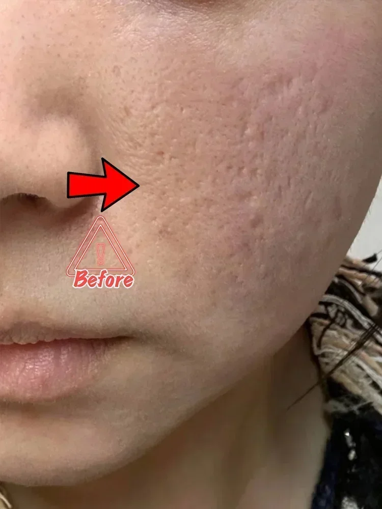 Acne Scar Removal Gel for Men – Professional Pothole Mark Repair Scrubs Treatments Tidesmit