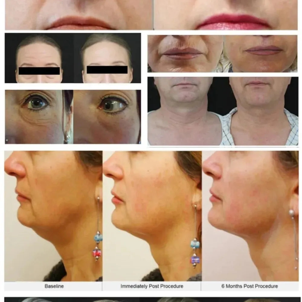 12D HIFU Face Lifting Machine - Professional Skin Firming Device Body Shaping Massage Equipment Tidesmit