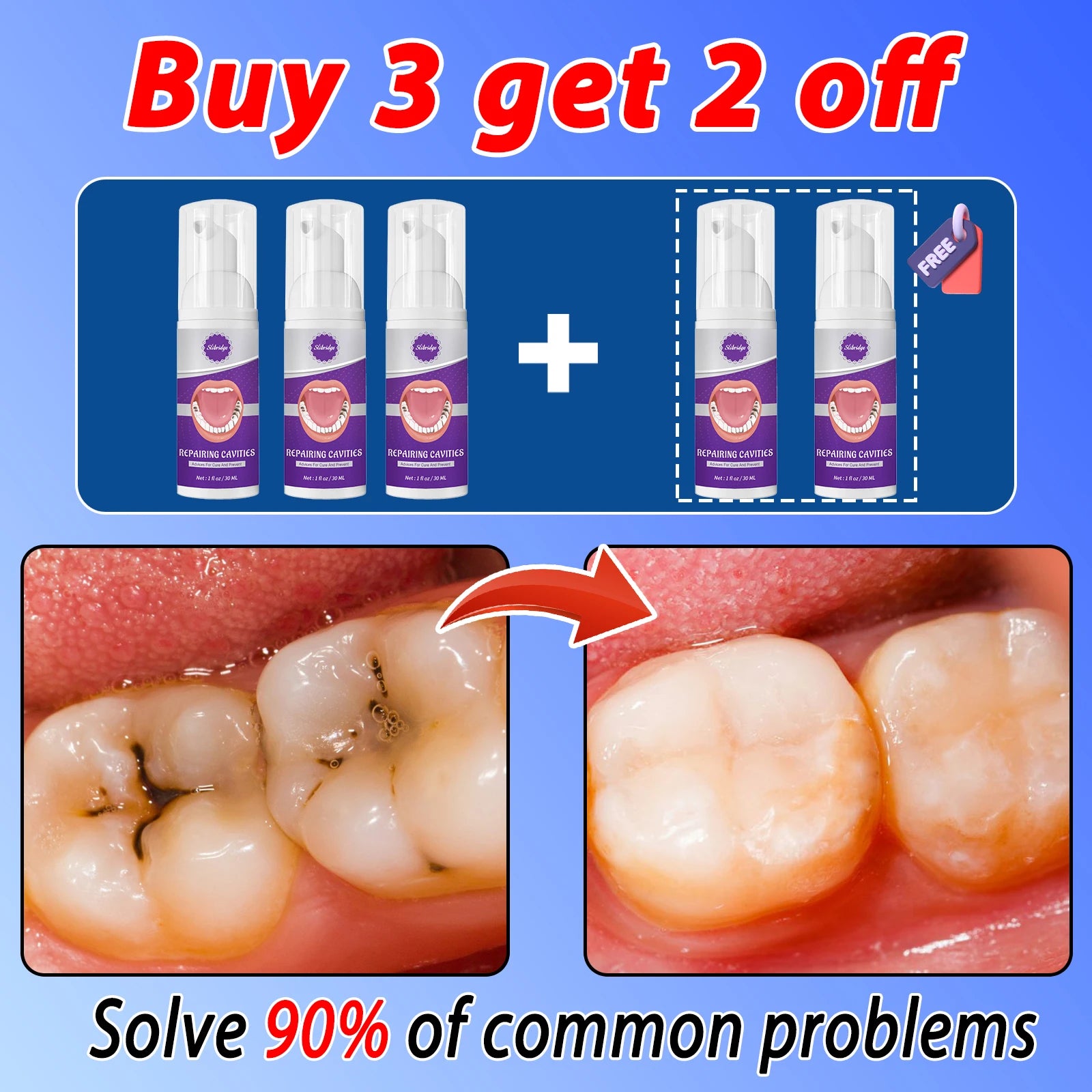 Tidesmit anti-caries teeth whitening gel for tooth decay repair and cavity protection