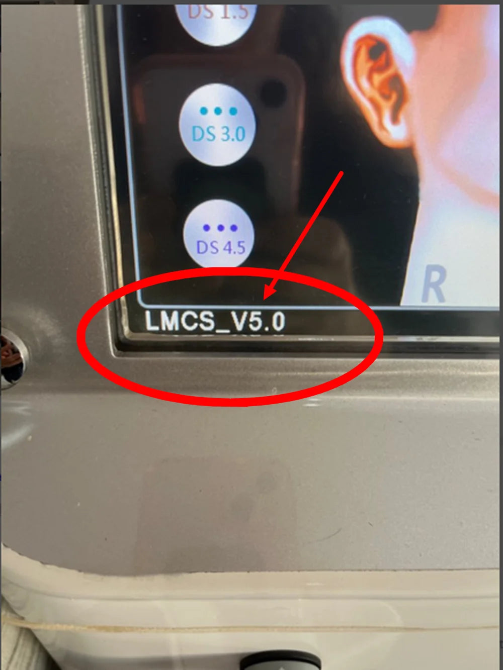 HIFU machine screen showing LMCS_V5.0 white chip cartridge settings for facial and body treatment depths.