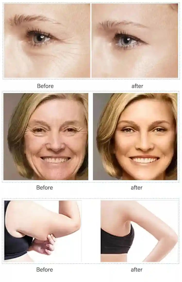 RF Face Lifting Machine for Skin Tightening and Wrinkle Reduction Eye Massage Instrument Tidesmit