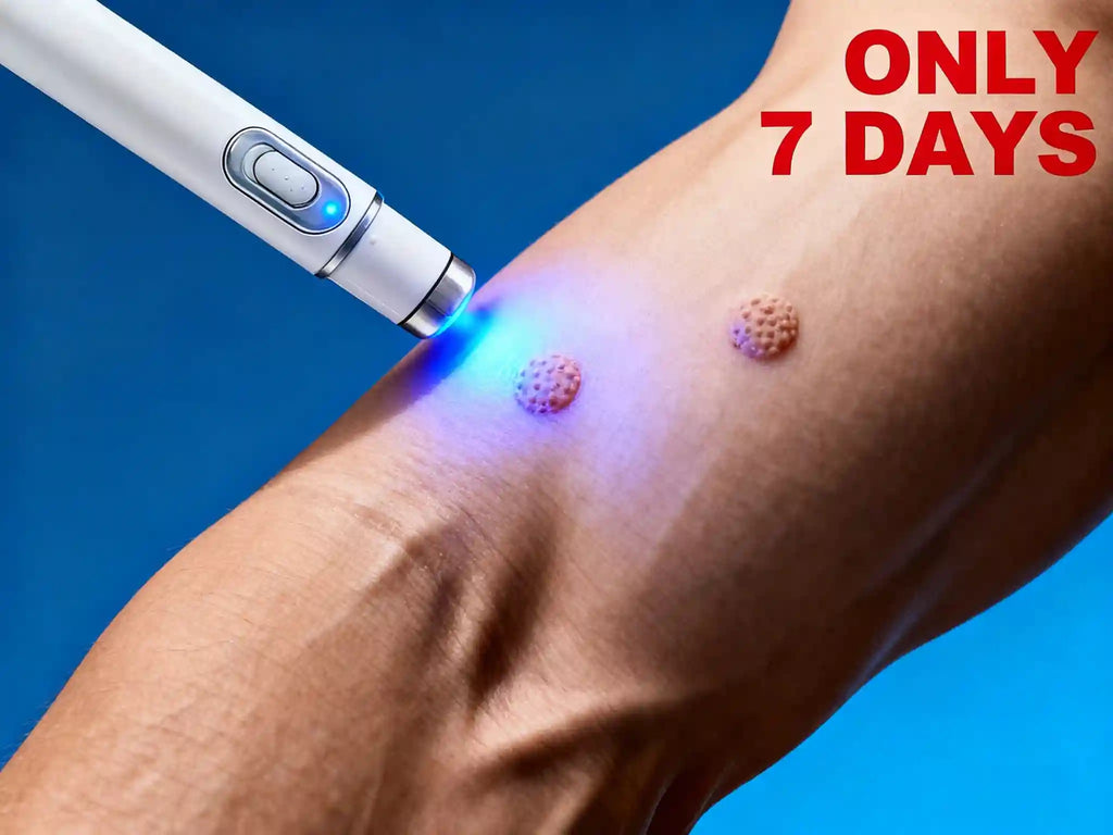 Blue Light Wart Removal Pen | Precision Skin Care Tool | Tidesmit Lip Care Buy 3 get 2 Free Tidesmit