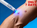 Blue Light Wart Removal Pen | Precision Skin Care Tool | Tidesmit Lip Care Buy 3 get 2 Free Tidesmit