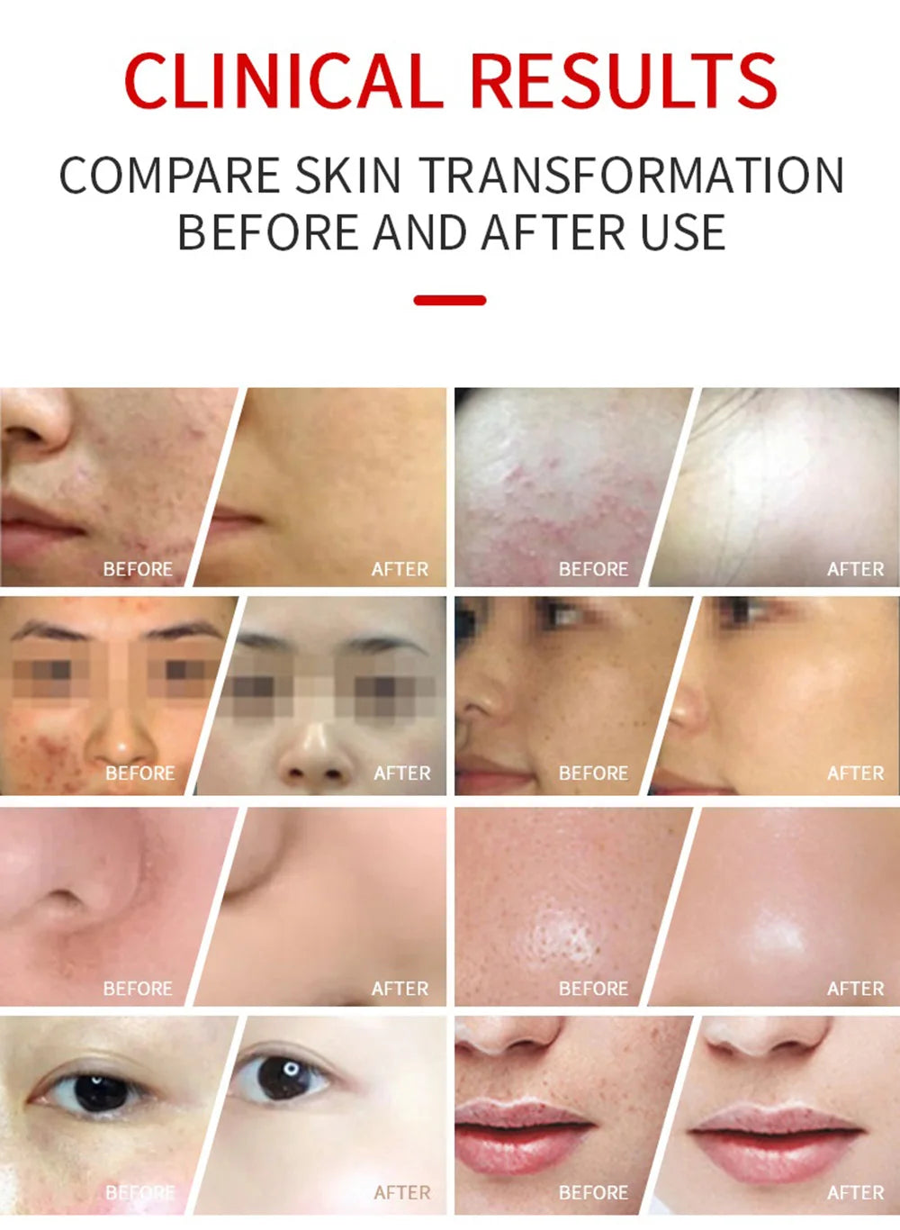 Before and after comparison photos showing skin improvement in acne, texture, and dark spots on different faces.