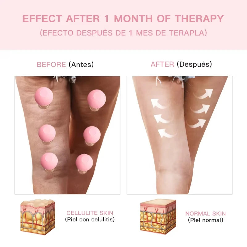Before and after comparison of leg skin showing pink rubber cupping tools used for cellulite reduction therapy.
