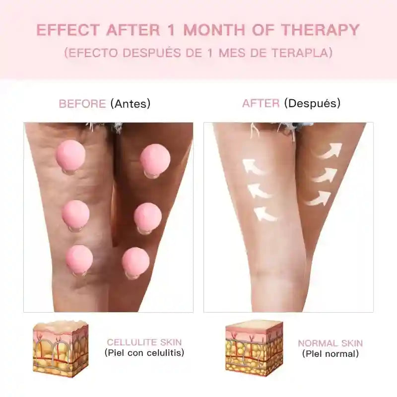 Before and after comparison of leg skin using pink rubber vacuum cupping tools to reduce the appearance of cellulite.