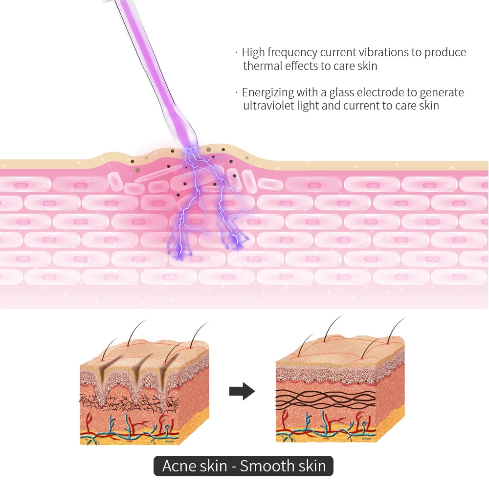 Illustration showing a glass electrode wand emitting purple light onto skin layers, transforming acne to smooth skin.